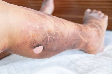 Sıcak yağdan dolayı hasta bacağında yanık, dış tabakayı etkileyen ikinci derece yanıklar.