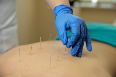 Akupunktur tedavisi kadının geri Spa'daki performans terapist el Close-up