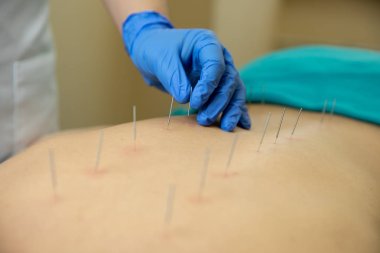 Akupunktur tedavisi kadının geri Spa'daki performans terapist el Close-up