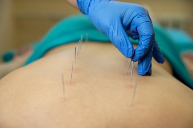 Akupunktur tedavisi kadının geri Spa'daki performans terapist el Close-up