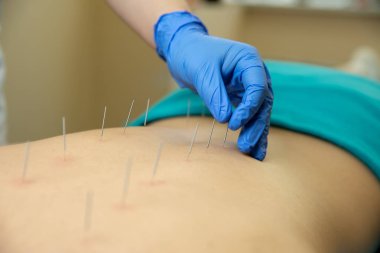 Akupunktur tedavisi kadının geri Spa'daki performans terapist el Close-up