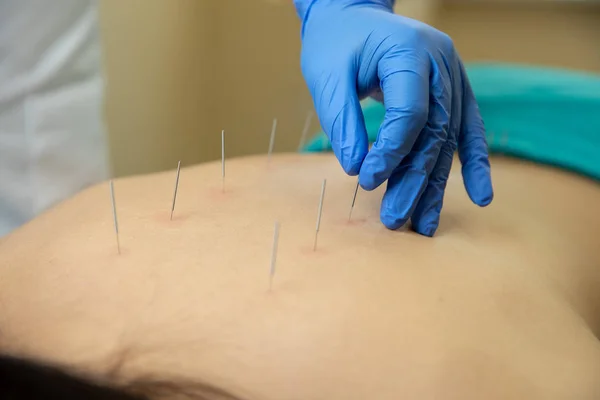 Primer Plano Terapeuta Mano Realizar Terapia Acupuntura Espalda Mujer Spa — Foto de Stock