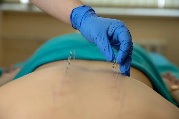 Primer Plano Terapeuta Mano Realizar Terapia Acupuntura Espalda Mujer Spa — Foto de Stock