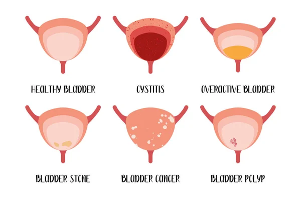 Enfermedades Vejiga Cistitis Vejiga Hiperactiva Cálculos Cáncer Pólipo Urología Ilustración — Archivo Imágenes Vectoriales