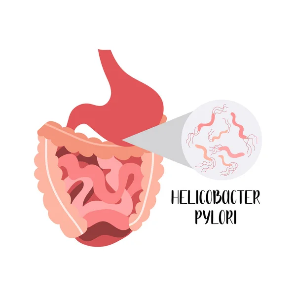 Das Menschliche Verdauungssystem Darm Dünn Und Dickdarm Helicobacter Pylori Vektorflache — Stockvektor