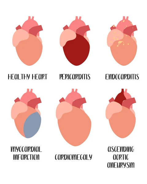 Coração Doenças Cardiovasculares Pericardite Endocardite Infarto Miocárdio Cardiomegalia Aneurisma Cardiologia —  Vetores de Stock