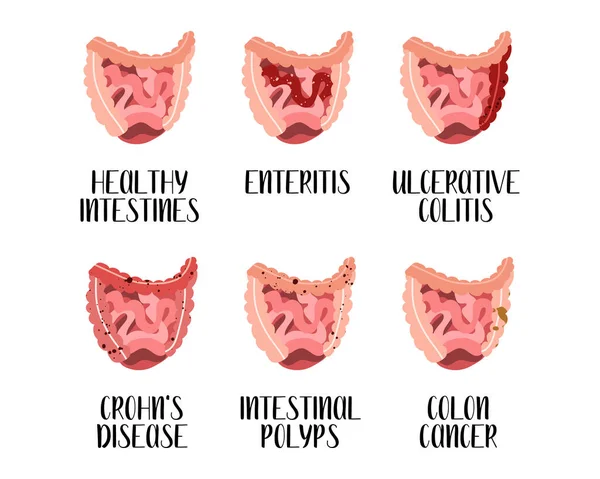 Bağırsak hastalıkları. Girişim, ülseratif kolit, Crohn hastalığı, polip, kolon kanseri. Gastroenteroloji. Vektör düz çizim. Broşür, pankart, iniş sayfası ve web sitesi için mükemmel.