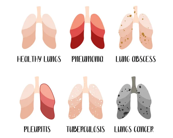 Choroby Płuc Zapalenie Płuc Ropień Płuc Zapalenie Opłucnej Gruźlica Rak — Wektor stockowy