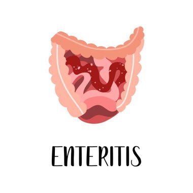Girişim, ince bağırsakta iltihap. Bağırsak hastalıkları. Gastroenteroloji. Vektör düz çizim. Broşür, pankart, iniş sayfası ve web sitesi için mükemmel.