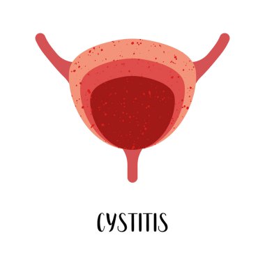 Sistit. İdrar kesesi hastalığı. Üroloji. Vektör düz çizim. Broşür, pankart, iniş sayfası ve web sitesi için mükemmel.