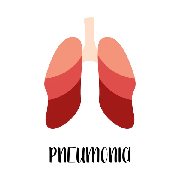 Zapalenie Płuc Zapalenie Płuc Choroba Płuc Pulmonologia Wektor Płaska Ilustracja — Wektor stockowy