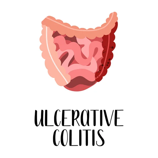 Ulcerative Colitis Intestines Diseases Gastroenterology Vector Flat Illustration Perfect Flyer — Stock Vector