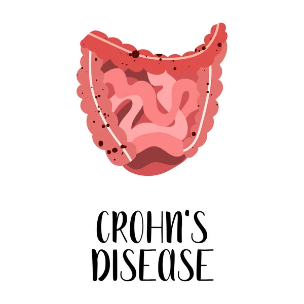 Penyakit Crohn Penyakit Usus Besar Gastroenterology Vektor Ilustrasi Datar Sempurna - Stok Vektor