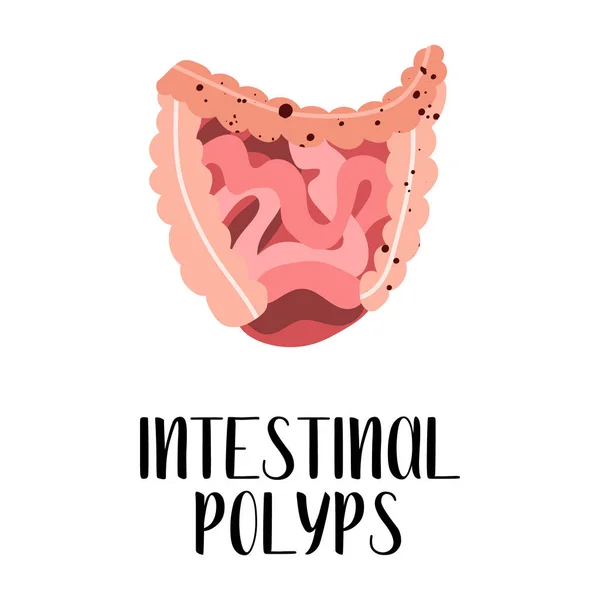 Pólipos Intestinales Enfermedades Intestinales Gastroenterología Ilustración Plana Vectorial Perfecto Para — Vector de stock