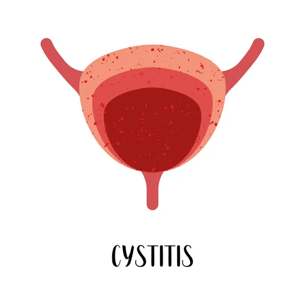 방광염 방광염 비뇨기과 일러스트 플라이어 팜플렛 현수막 착륙장 사이트 — 스톡 벡터