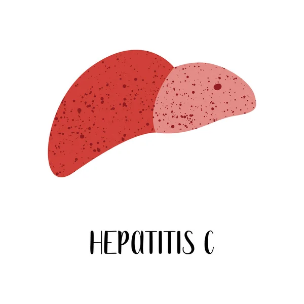 Hepatitis Penyakit Hati Hepatology Tahap Kerusakan Hati Vektor Ilustrasi Datar - Stok Vektor