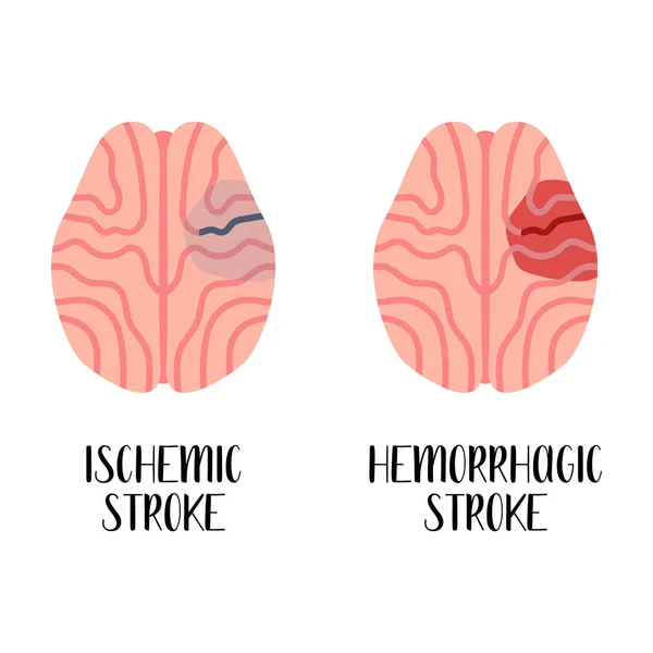 Iskemik Dan Stroke Hemoragik Penyakit Otak Neurobiologi Vektor Ilustrasi Datar - Stok Vektor