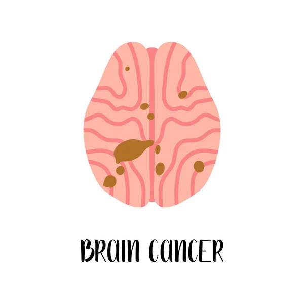 Cáncer Cerebral Carcinoma Diagnóstico Enfermedades Cerebrales Oncología Neurobiología Ilustración Plana — Vector de stock