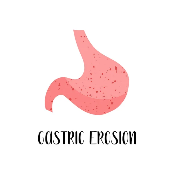 Erosión Gástrica Enfermedad Estómago Gastroenterología Ilustración Plana Vectorial Perfecto Para — Vector de stock