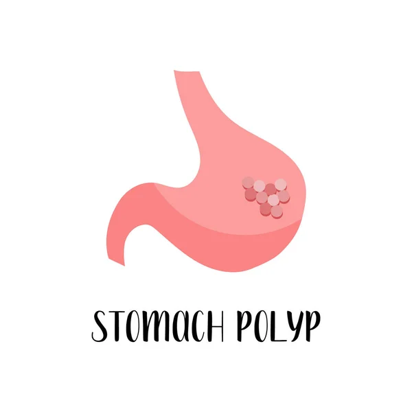Magpolyp Magsjukdom Gastroenterologi Vektor Platt Illustration Perfekt För Flygblad Medicinsk — Stock vektor