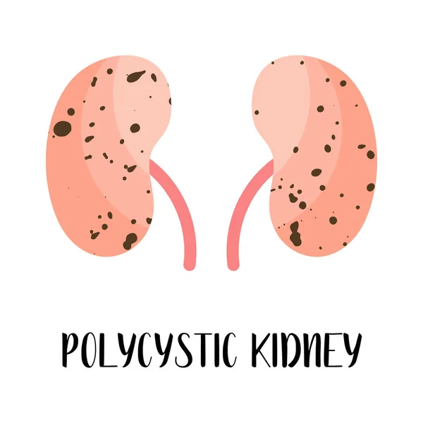 Policystyczna Nerka Choroba Nerek Urologia Wektor Płaska Ilustracja Idealny Ulotkę — Wektor stockowy