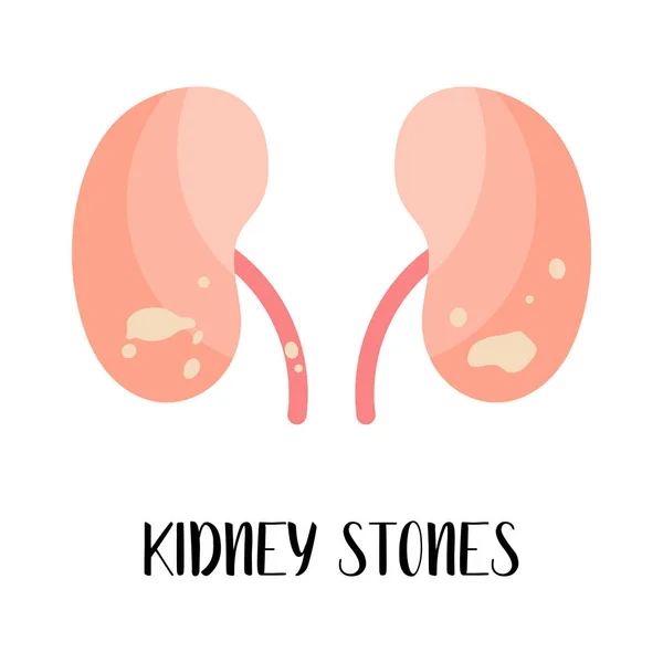 Cálculos Renales Enfermedad Renal Urología Ilustración Plana Vectorial Perfecto Para — Vector de stock