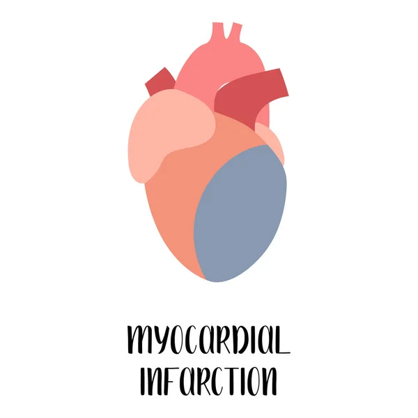 Infarto Miocardio Corazón Enfermedades Cardiovasculares Cardiología Ilustración Plana Vectorial Para — Archivo Imágenes Vectoriales