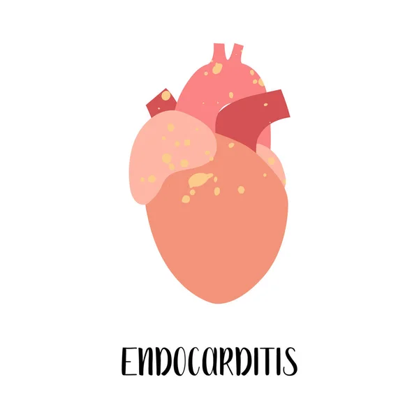 Endocarditis Corazón Enfermedades Cardiovasculares Cardiología Ilustración Plana Vectorial Para Volante — Archivo Imágenes Vectoriales