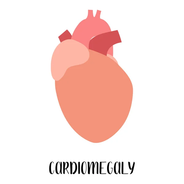 Cardiomegalia Corazón Agrandado Enfermedad Cardiovascular Cardiología Ilustración Plana Vectorial Para — Archivo Imágenes Vectoriales