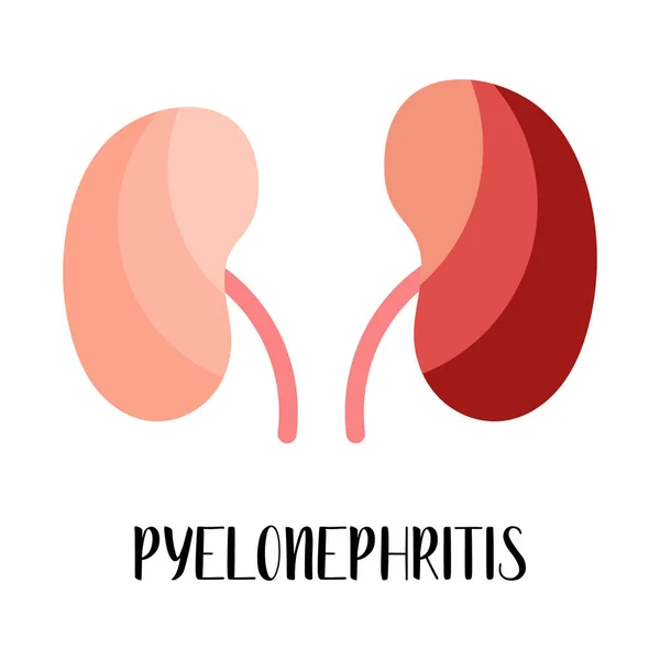 Pyelonephritis. Kidneys disease. Urology. Vector flat illustration. Perfect for flyer, medical brochure, banner, landing page, website — Stock Illustration Pyelonephritis Kidneys Disease Urology Vector Flat Illustration Perfect Flyer Medical Stock Vector