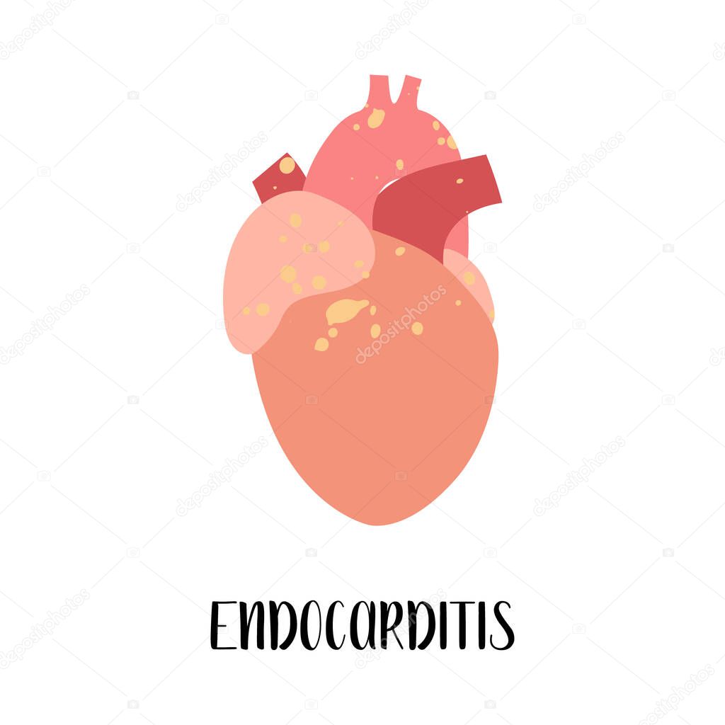 Endocarditis. Heart, cardiovascular disease. Cardiology. Vector flat illustration. For flyer, medical brochure, banner, landing page, web