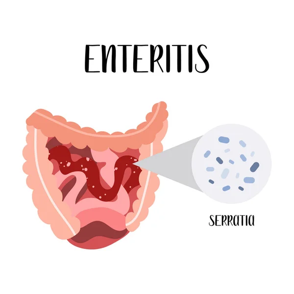 Enteritis Inflammation Small Intestine Serratia Bacteria Gut Diseases Gastroenterology Vector — Stock Vector