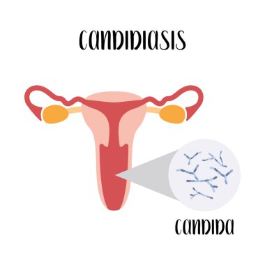 Candiasis. Candida. Bakteriyel vajinal hastalık. Dişi üreme sistemi. Jinekoloji. Vektör düz çizgi film illüstrasyonu