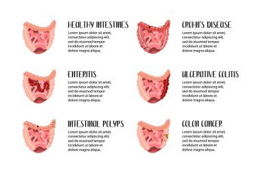Bağırsak hastalıkları. Girişim, ülseratif kolit, Crohn hastalığı, polip, kolon kanseri. Gastroenteroloji. Vektör düz çizim. Broşür, pankart, iniş sayfası ve web sitesi için mükemmel.