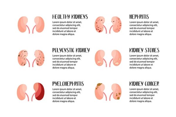 Njursjukdomar Polycystisk Njure Pyelonefrit Nefrit Stenar Cancer Urologi Vektor Platt — Stock vektor