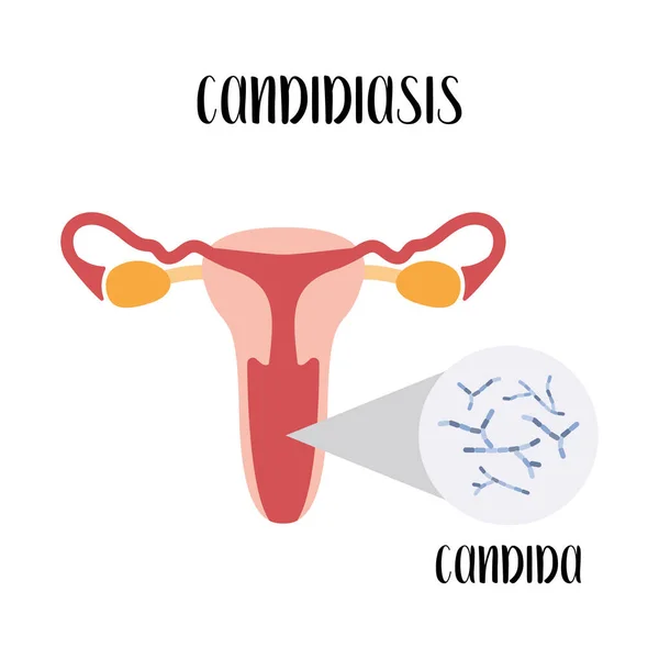 칸디디아 세균질 질환이야 부인과 — 스톡 벡터