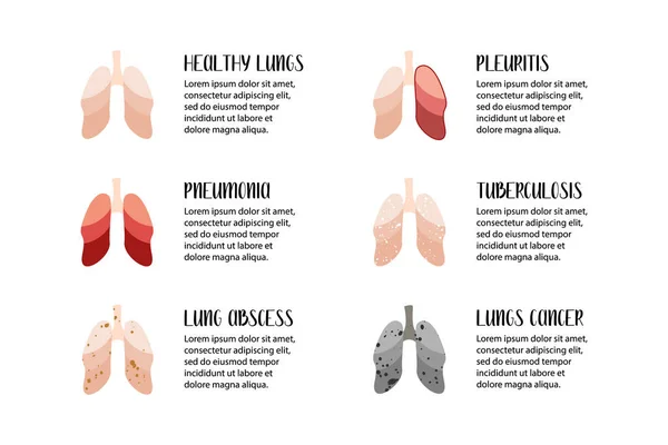 隆氏病肺炎 肺脓肿 胸膜炎 肺结核 肺病学 矢量平面插图 完美的传单 医疗小册子 登陆页 — 图库矢量图片