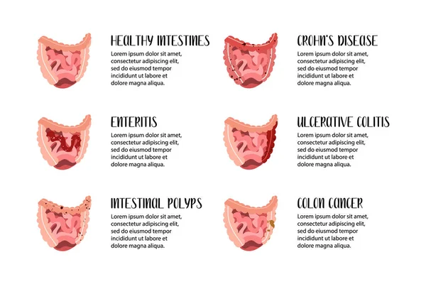 Bağırsak hastalıkları. Girişim, ülseratif kolit, Crohn hastalığı, polip, kolon kanseri. Gastroenteroloji. Vektör düz çizim. Broşür, pankart, iniş sayfası ve web sitesi için mükemmel.