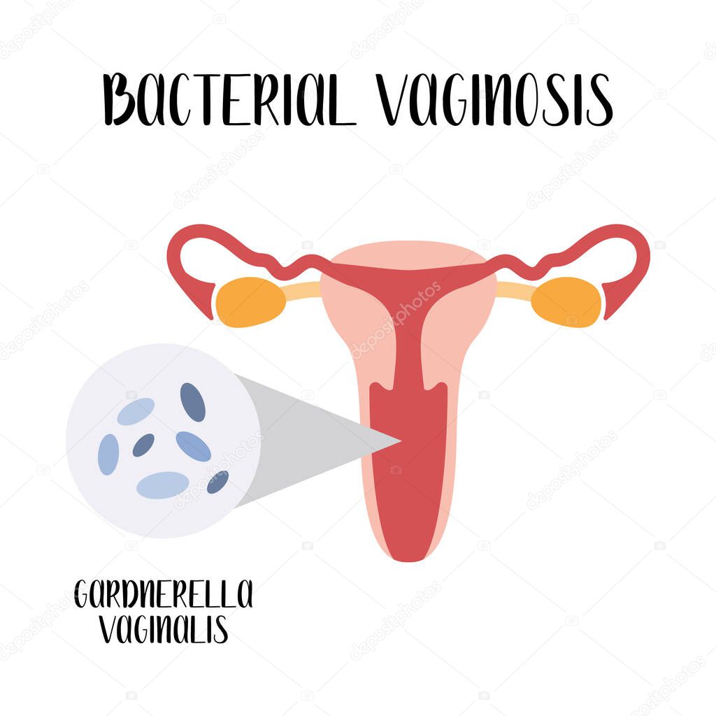 Bacterial vaginosis. Gardnerella vagnalis. Bacterial vaginal disease. Female reproductive system. Gynecology. Vector flat cartoon illustration