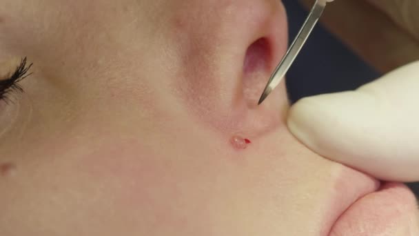 Fechar Extremo Detalhe Remoção Marca Nascença Laser Clínica Dermatológica Paciente — Vídeo de Stock