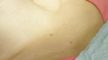 Aşırı yakın kadar güzellik işareti cerrahi önce dezenfekte doktor. Genç bayan hasta vücudunda iyi huylu doku tedavisi ve cilt kozmetik prosedür için hazırlanıyor dermatolog
