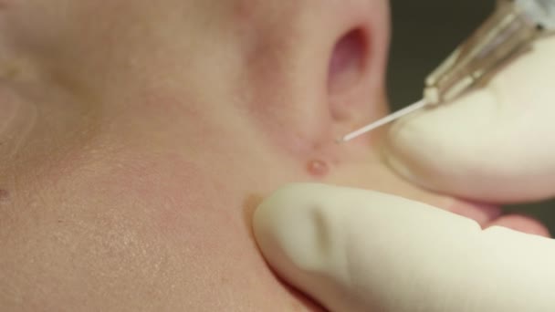 Extreme Nahaufnahme Dermatologe Injiziert Lokalanästhetikum Den Muttermal Vor Chirurgischer Entfernung — Stockvideo