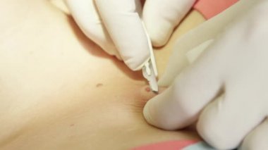 Aşırı yakın: güzellik işareti insan derisi üzerinde cerrahi olarak çıkarılması detayını. İyi huylu köstebek preventively estetik kliniği bir güzellik uzmanı tarafından kaldırılmış olan lokal anestezi altında tanınmaz halde hasta