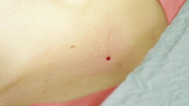 Aşırı yakın: hastanın Doğum lekesi cerrahi olarak çıkarılması sonra damla kan insan derisi üzerinde. Küçük yara kanseri önlemek için bir köstebek kaldırma önleyici dermatolojik işlemden sonra kanama