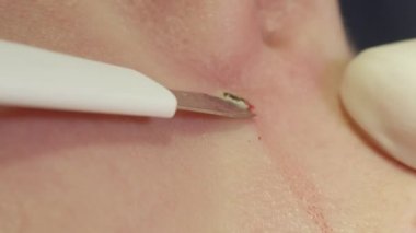 Aşırı yakın kadar detay lazer Doğum lekesi kaldırma burnunun yüzünde. Özel dermatolojik klinik kozmetik yordamda ameliyatla bir köstebek sahip tanınmaz bayan hasta