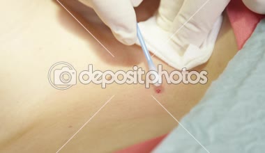 Aşırı yakın: kanama yara sonra Doğum lekesi cilt genç bir kadının üzerinde cerrahi olarak çıkarılması. Sonra hastanın boyun güzellik işareti kaldırma dermatolojik yordam kesim dezenfekte