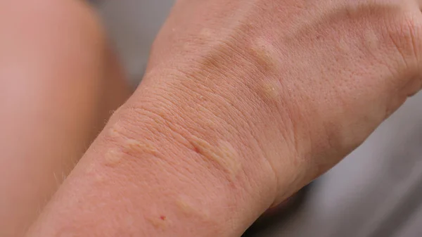Dof 无法辨认的年轻女子的手臂上充满了唠叨的肿胀的蚊虫叮咬 详细的看法未知的高加索女性的手遭受一个烦人的过敏反应 发痒的皮疹 — 图库照片