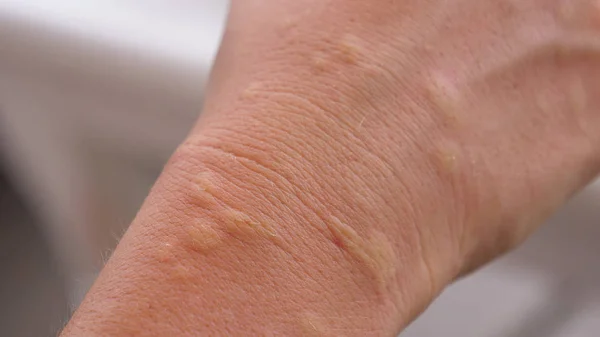 Dof 一个烦人的发痒过敏反应后 女性手背的详细视图 无法辨认的女性手患有疼痛皮疹肿胀 白种人手臂上的撞击声 — 图库照片
