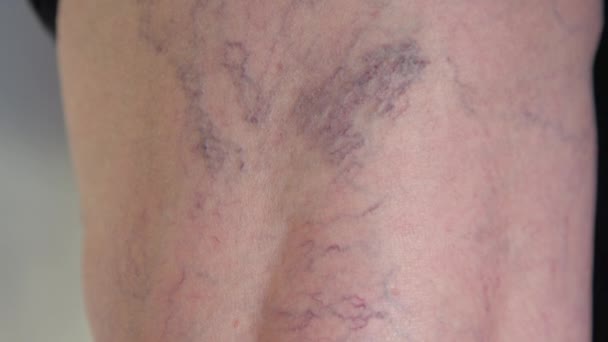 スローモーション クローズアップ マクロ 認識できないシニアレディの膝の背中を曲がるねじれ静脈 高齢女性の冠動脈問題のクローズアップ検査 紫色の静脈瘤の詳細なショット — ストック動画