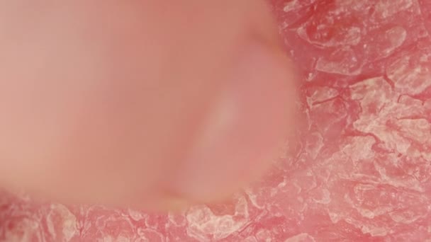 Chiudi Macro Dettaglio Dell Eczema Della Pelle Psoriasica Arrossata Infiammata — Video Stock